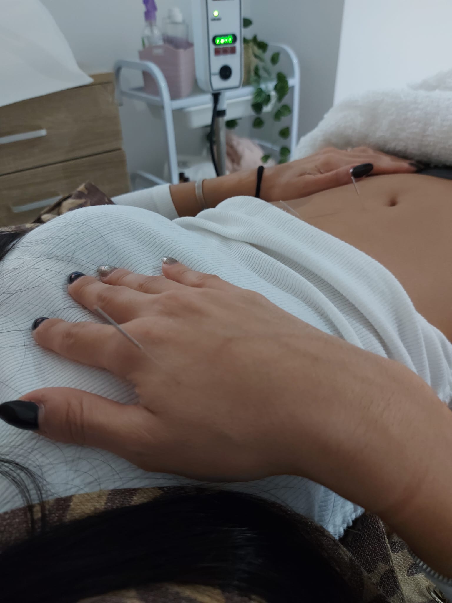 דיקור סיני לפוריות ואיזון הורמונלי