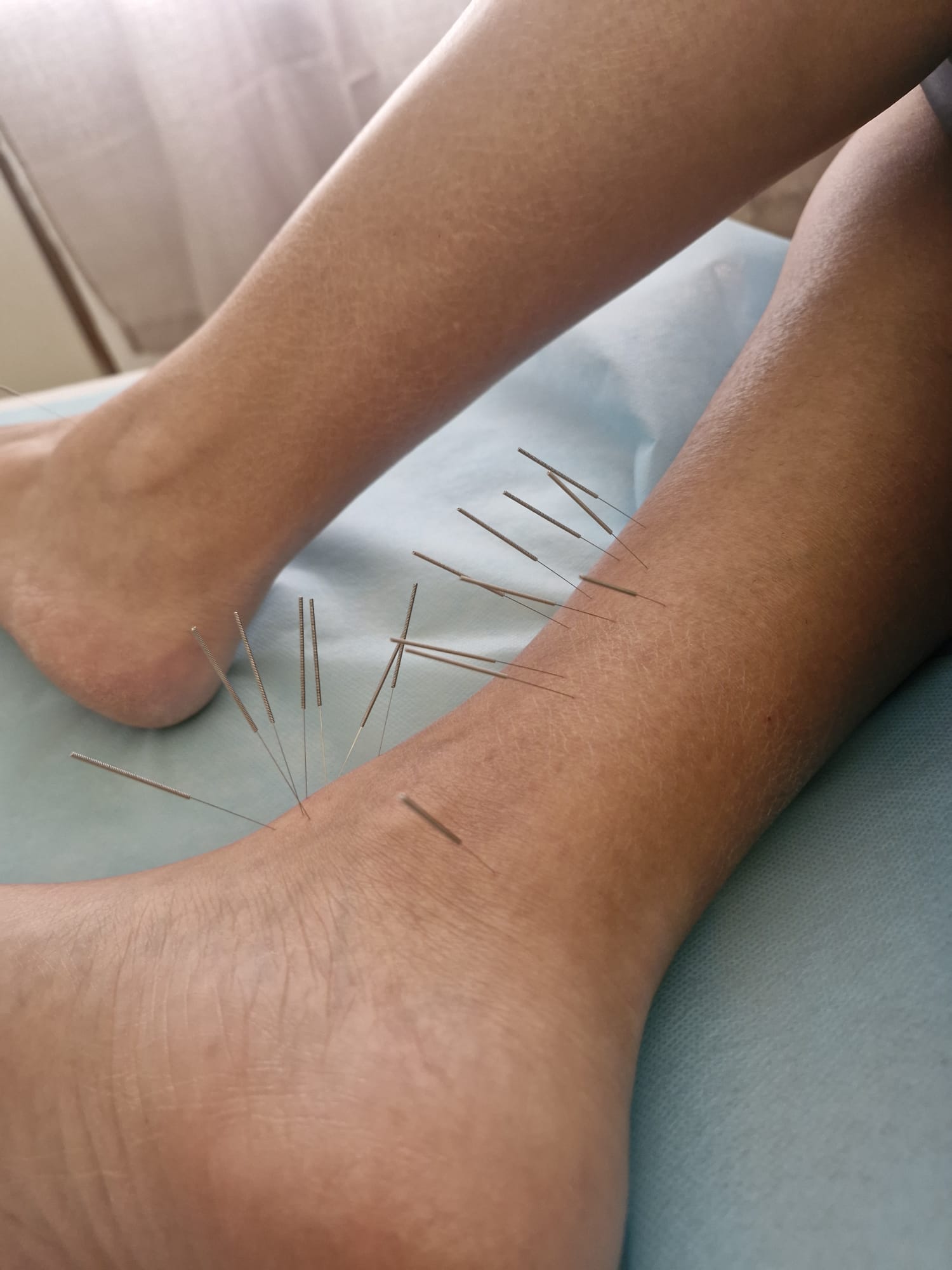 דיקור סיני בכפות הרגליים לשיפור זרימת אנרגיה