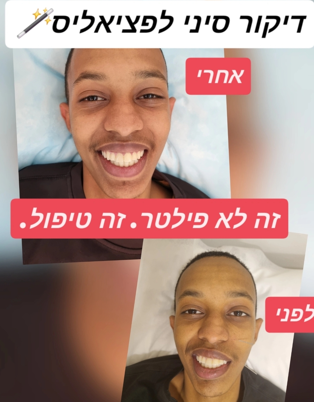 דיקור קוסמטי לפנים - לפני ואחרי טיפול פציאליס - זה לא פילטר, זה טיפול