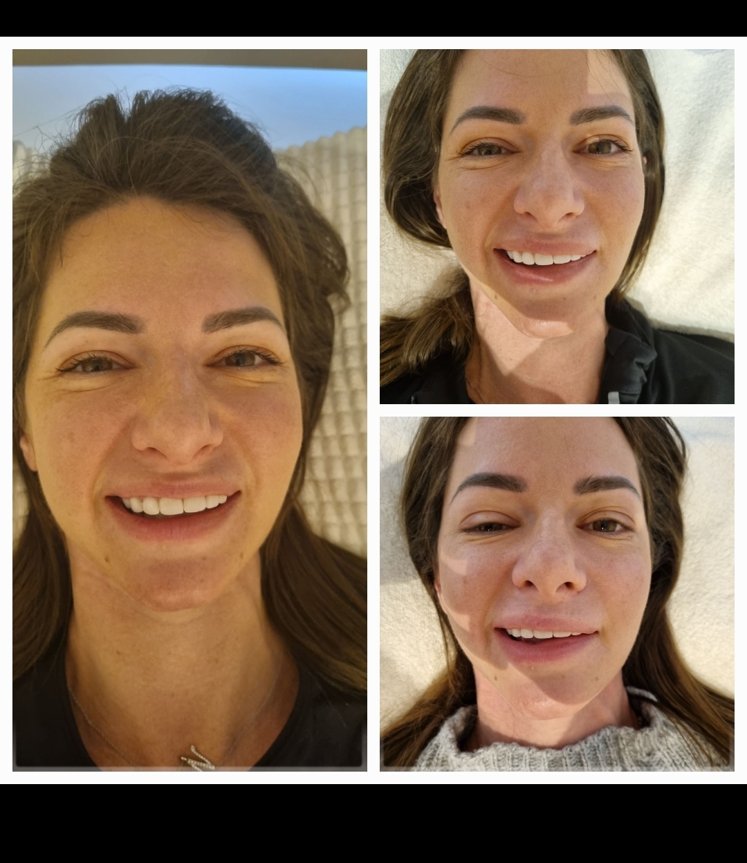 תוצאות דיקור קוסמטי לנשים - שיפור מרקם העור והפחתת קמטים